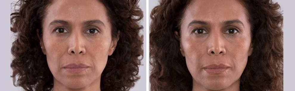 Sculptra before and after example, front view showing fuller cheeks and softer smile lines, Sculptra San Diego