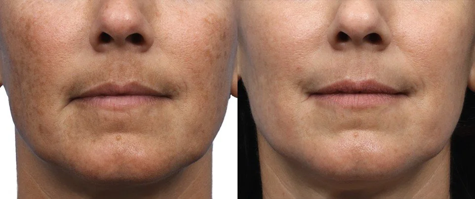 Lutronic Ultra laser before and after with lighter sun spots and brown patches on the cheeks and around the mouth, San Diego