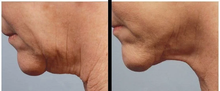 Before and after Forma showing tightened jowl and neck skin in profile