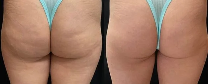 Morpheus8 body skin tightening before and after on the buttocks and thighs, San Diego