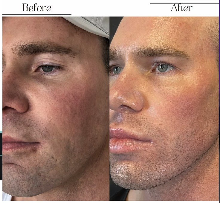 Morpheus8 for men before and after, smoother skin and a firmer jawline, San Diego
