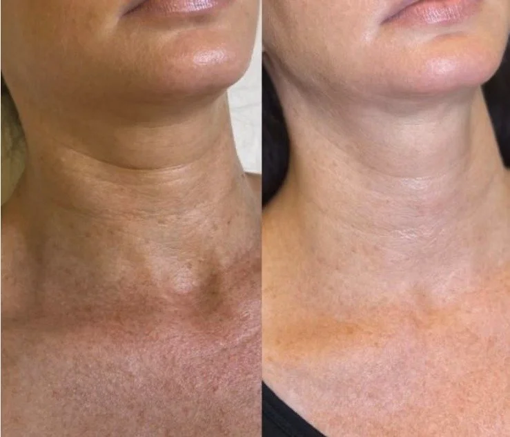 Morpheus8 neck skin tightening before and after, smoother neck lines, San Diego