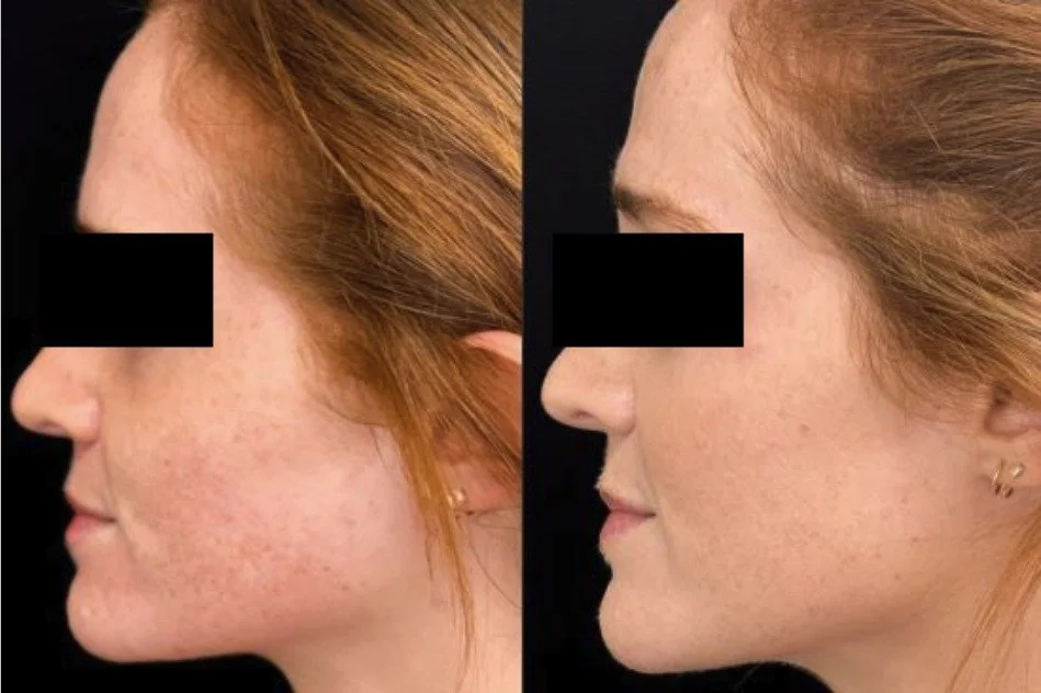 Morpheus8 acne scar before and after, smoother cheek texture, San Diego