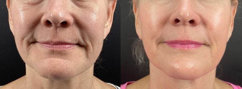 Morpheus8 RF microneedling before and after on the lower face and jawline, San Diego