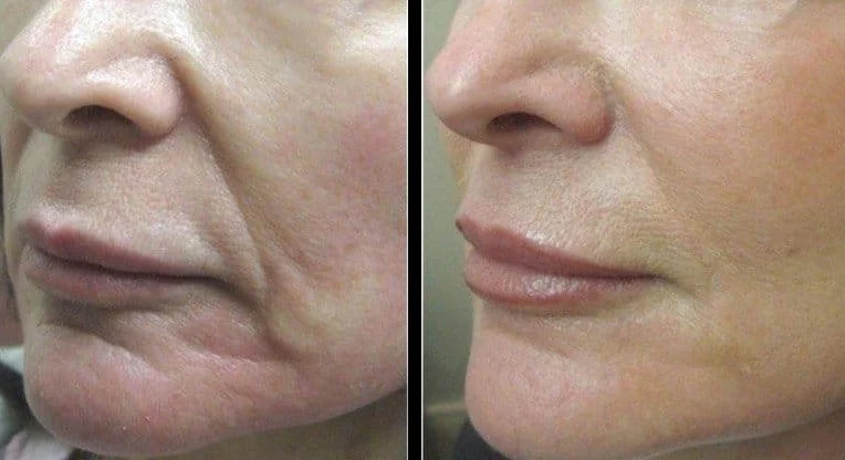Before and after Forma radiofrequency showing smoothed nasolabial folds and firmer lower face