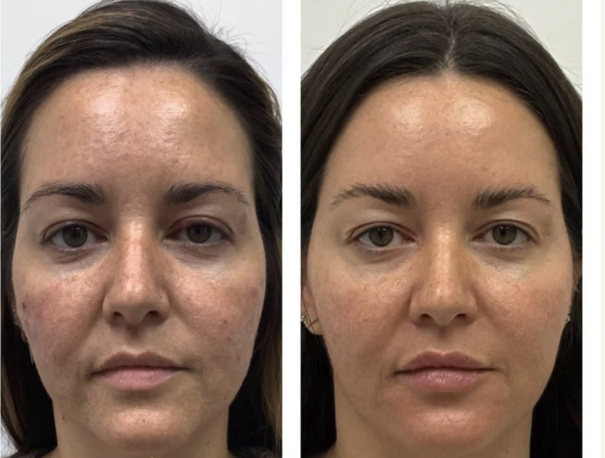 Morpheus8 before and after with brighter, more even skin tone and refined texture, Hillcrest