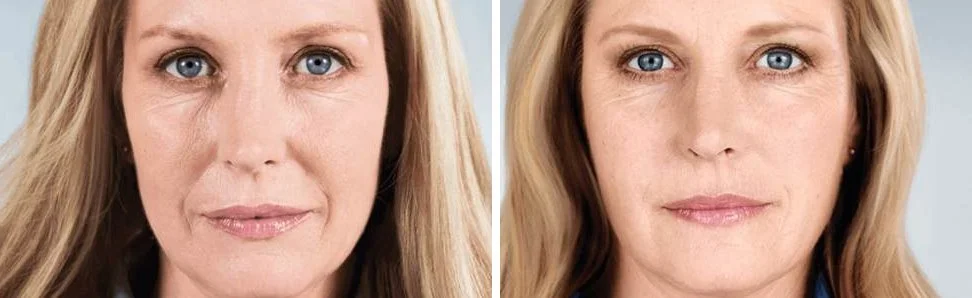 Sculptra before and after example, front view showing restored midface volume and smoother skin, Sculptra collagen stimulator San Diego