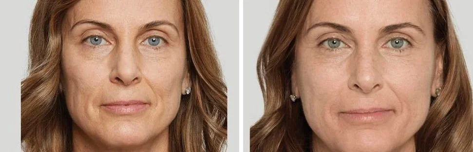 Sculptra before and after example, front view showing lifted cheeks and softened folds around the mouth, Sculptra Hillcrest San Diego