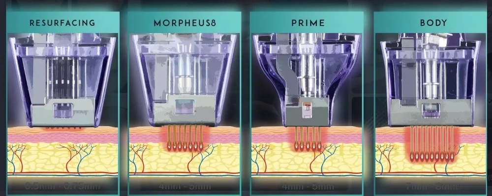 Morpheus8 tips showing RF microneedling depths for resurfacing, face, Prime and body treatments