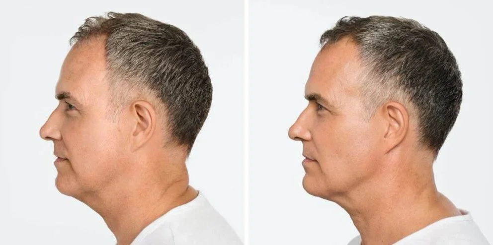 Radiesse before and after example, side profile showing a more defined jawline and chin, Radiesse jawline filler San Diego