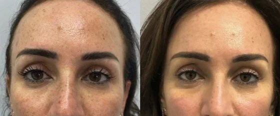 Thulium laser before and after with fewer freckles and sun spots across the face for a brighter, more even tone, San Diego