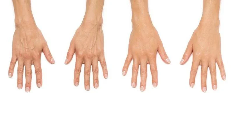 Radiesse before and after example, back of the hands showing less visible veins and tendons, Radiesse hand rejuvenation San Diego