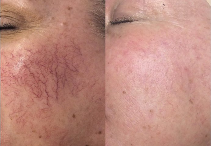 Before and after Vasculaze laser treatment showing a dense network of broken capillaries cleared from a woman's cheek