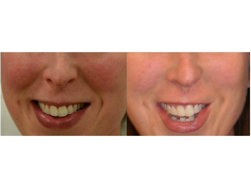 Rosacea pre and post laser treatment
