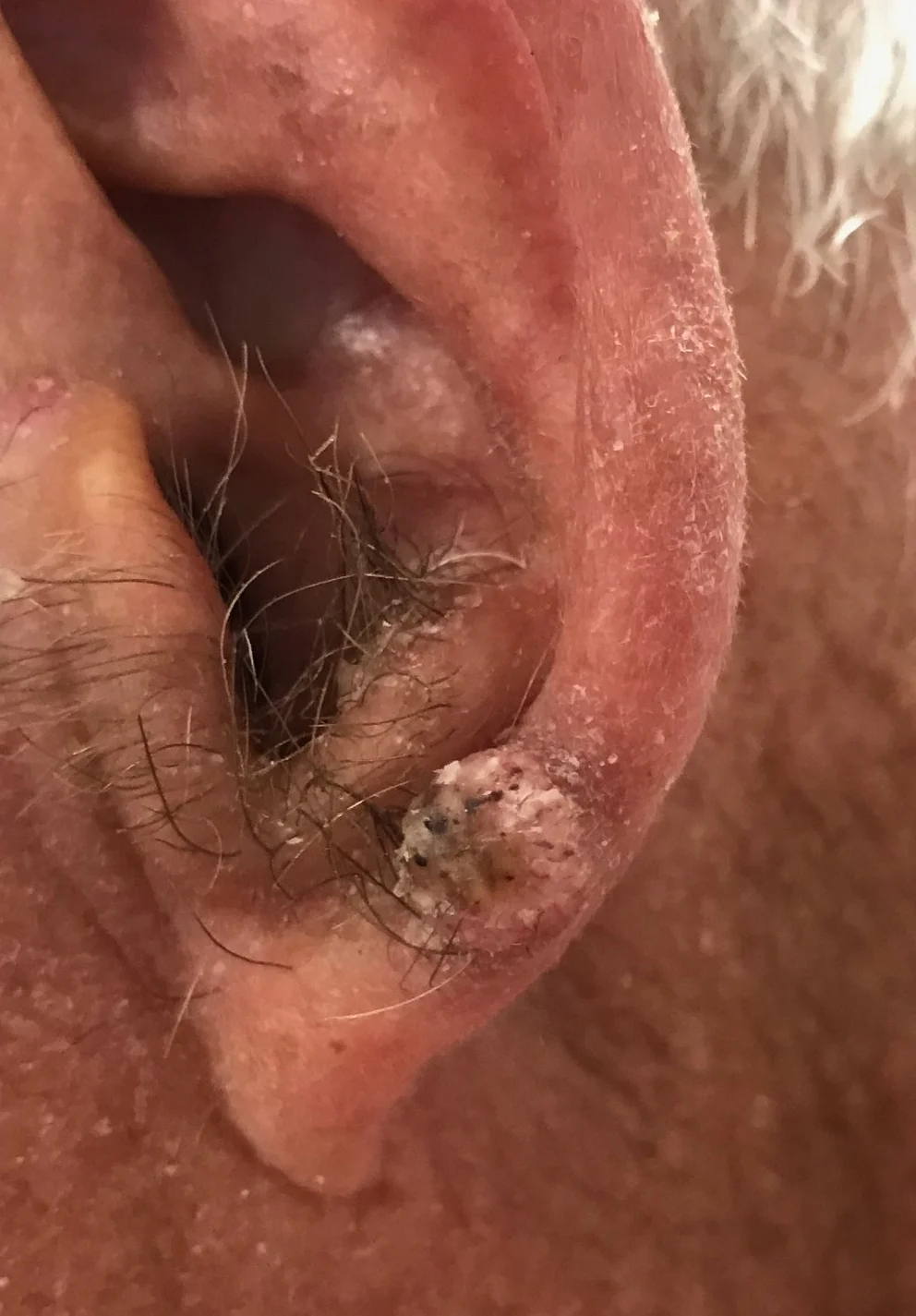 Squamous cell carcinoma on the ear