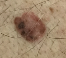 Malignant melanoma in situ