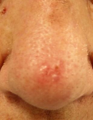 Basal cell carcinoma: learn more