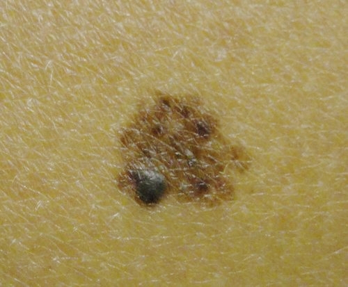 Melanoma