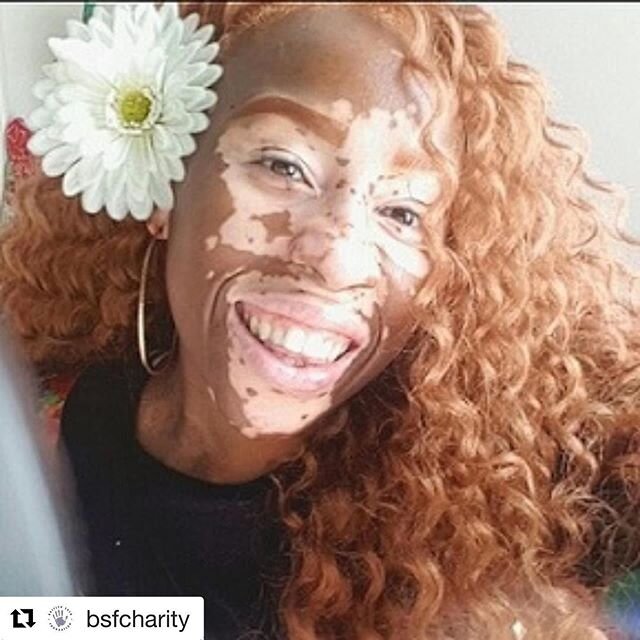 #Repost @bsfcharity with @get_repost
・・・
It's #WorldVitiligoDay! Read stories from people with #vitiligo:⠀
⠀
Aisha - &quot;Living with vitiligo is difficult, because you exist in a world that doesn&rsquo;t know how to perceive you.&quot; https://buff