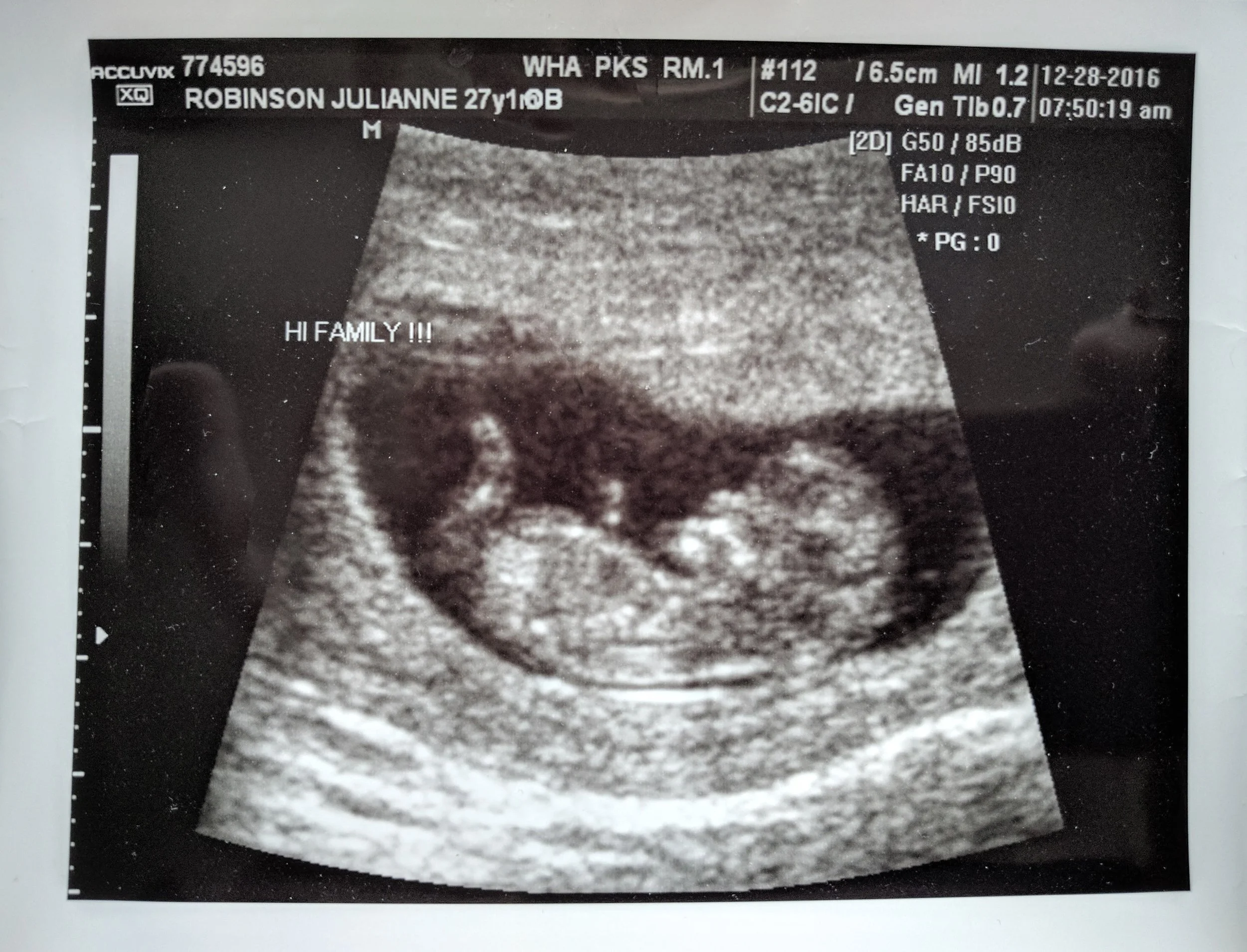 12 WEEK ULTRASOUND