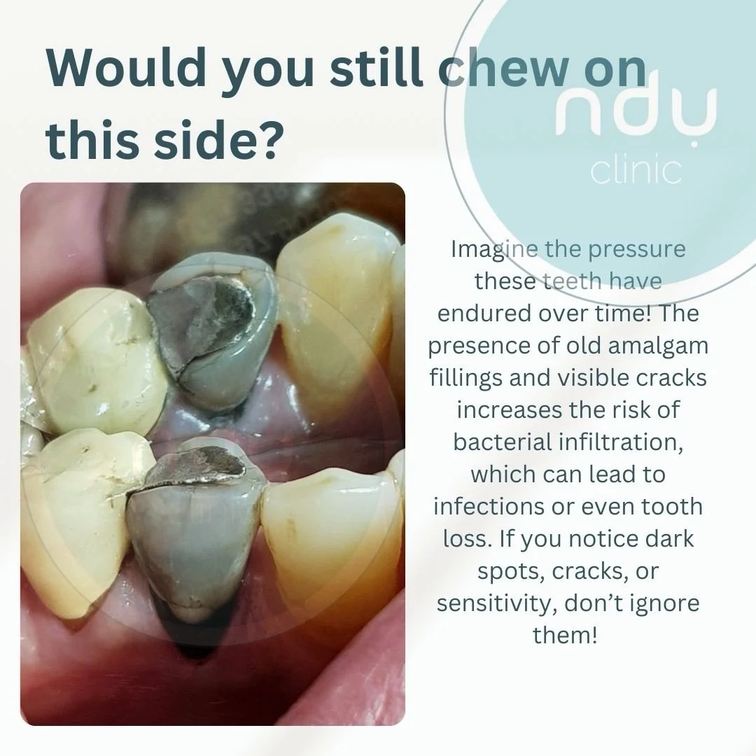 This is dental art in its true form 🦷✨ &mdash; a heavily filled, root canal&ndash;treated tooth, noticeable by the discolouration.

Another reason for the discolouration is the large amalgam filling, which can leave its mark on the tooth itself ⚙️. 