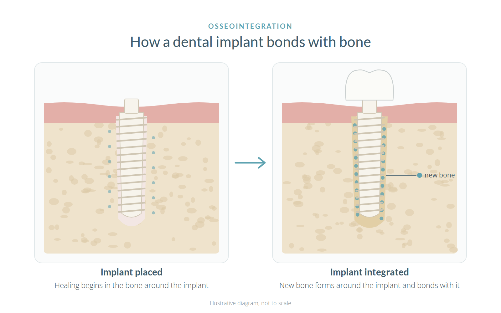 Diagram showing new bone forming around a ceramic dental implant as it integrates with the jaw