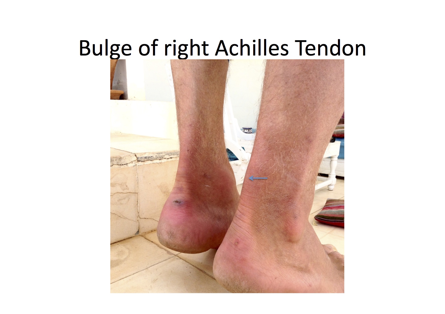 Partial Tear Of The Achilles Tendon - Ankle - Conditions - Musculoskeletal  - What We Treat - Physio.co.uk