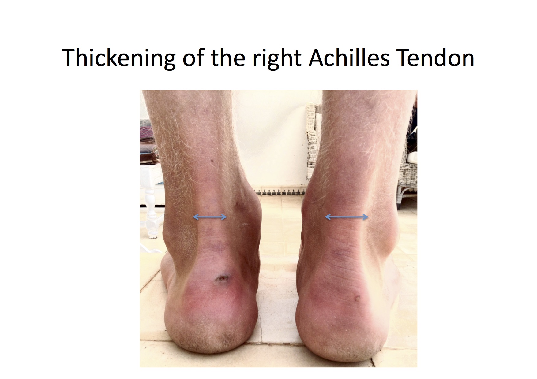 Achilles Tendonitis Basics | Florida Orthopaedic Institute