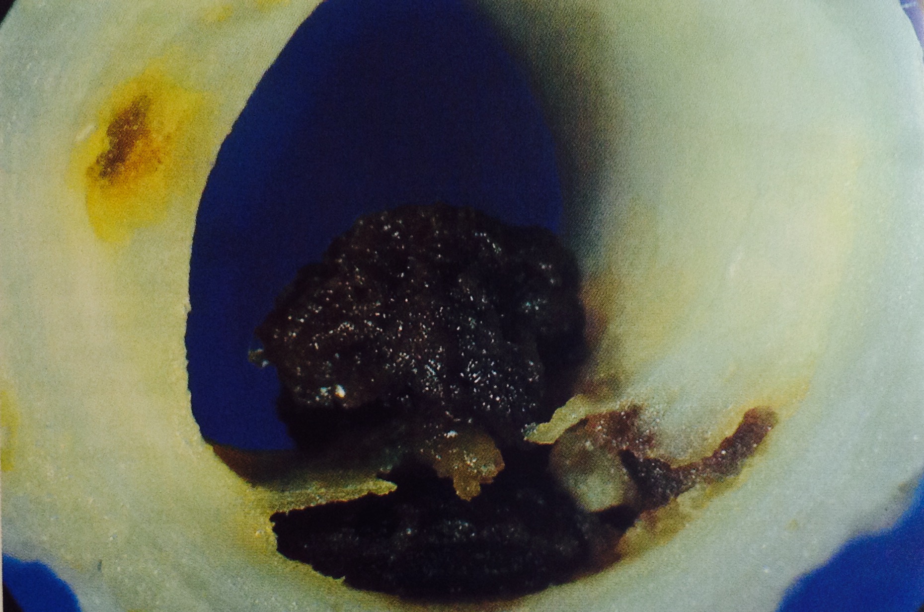 Cross-section of an artery around the heart muscle showing a ruptured plaque at the bottom of the picture. There is a blood clot inside the plaque extending up into the hallow lumen (tube) of the artery. The plaque usually ruptures because of inflammatory cells weakening the surface layer.