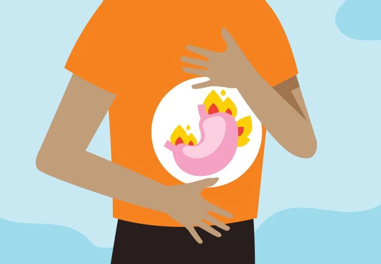 Acid Reflux