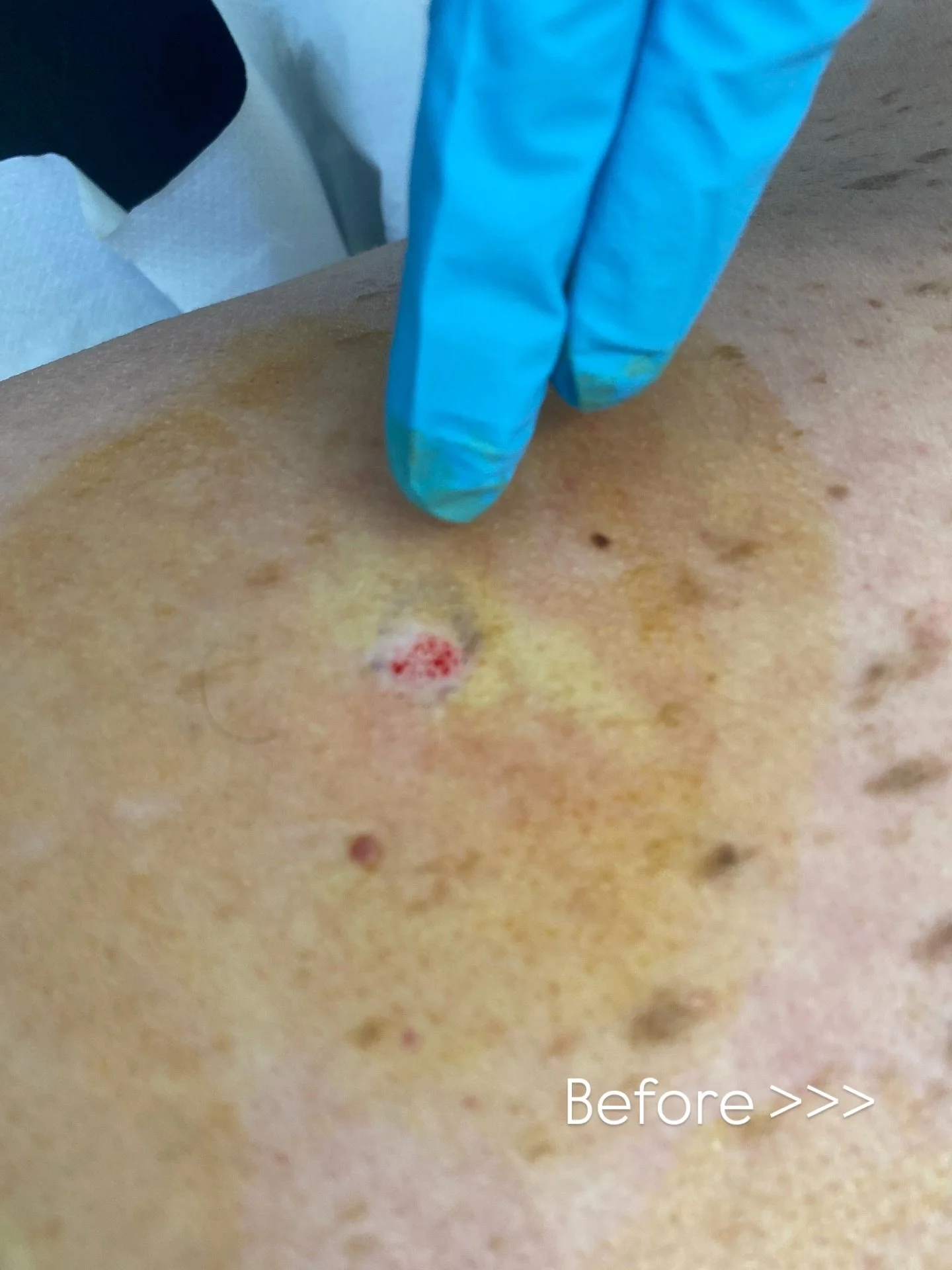 Satisfying seborrheic keratosis removal 👀

😍 Shave excision and light electrocautrry to stop bleeding. These are never cancerous, people just like them removed. 

☀️ They&rsquo;re often genetic and very common in countries with high sun exposure 

