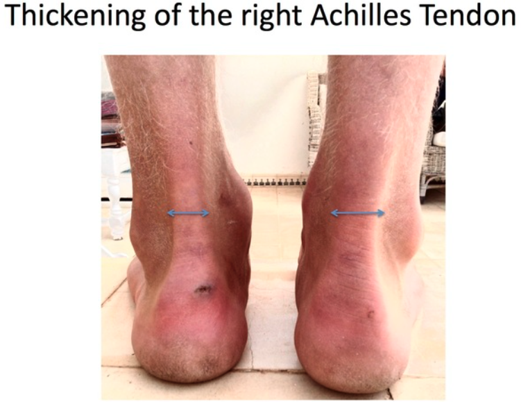 Inflammation My Achilles Tendon Is Swollen Lump Next To Achilles