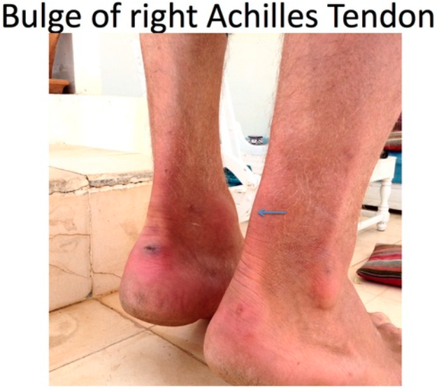 Heel & Achilles Tendon Stretch – Arun Shanbhag
