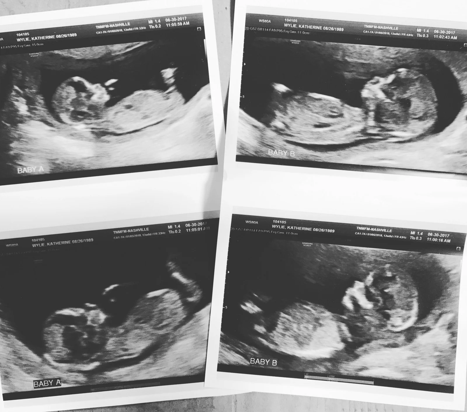 Jack and Ben's Birth Story