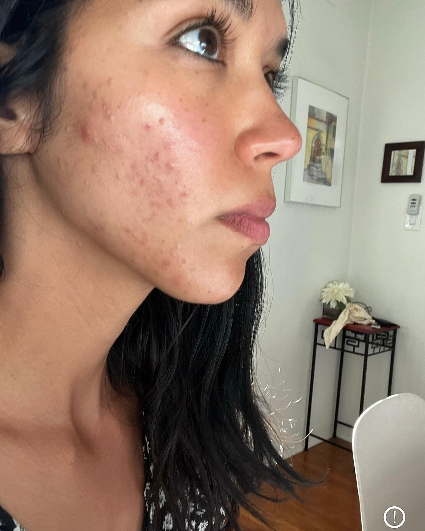 Sharing something a little private today in hopes that it can inspire anyone else going through something similar. 

Like I had for the last 9 years before, on New Year&rsquo;s Eve 2022 I vowed to focus on clearing my acne, regulating my period and g