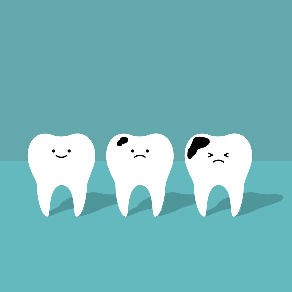 cavities and fillings — Blog — Glenn Reit . - Dentist Near Me, Upper  East Side, Manhattan, NYC 10028