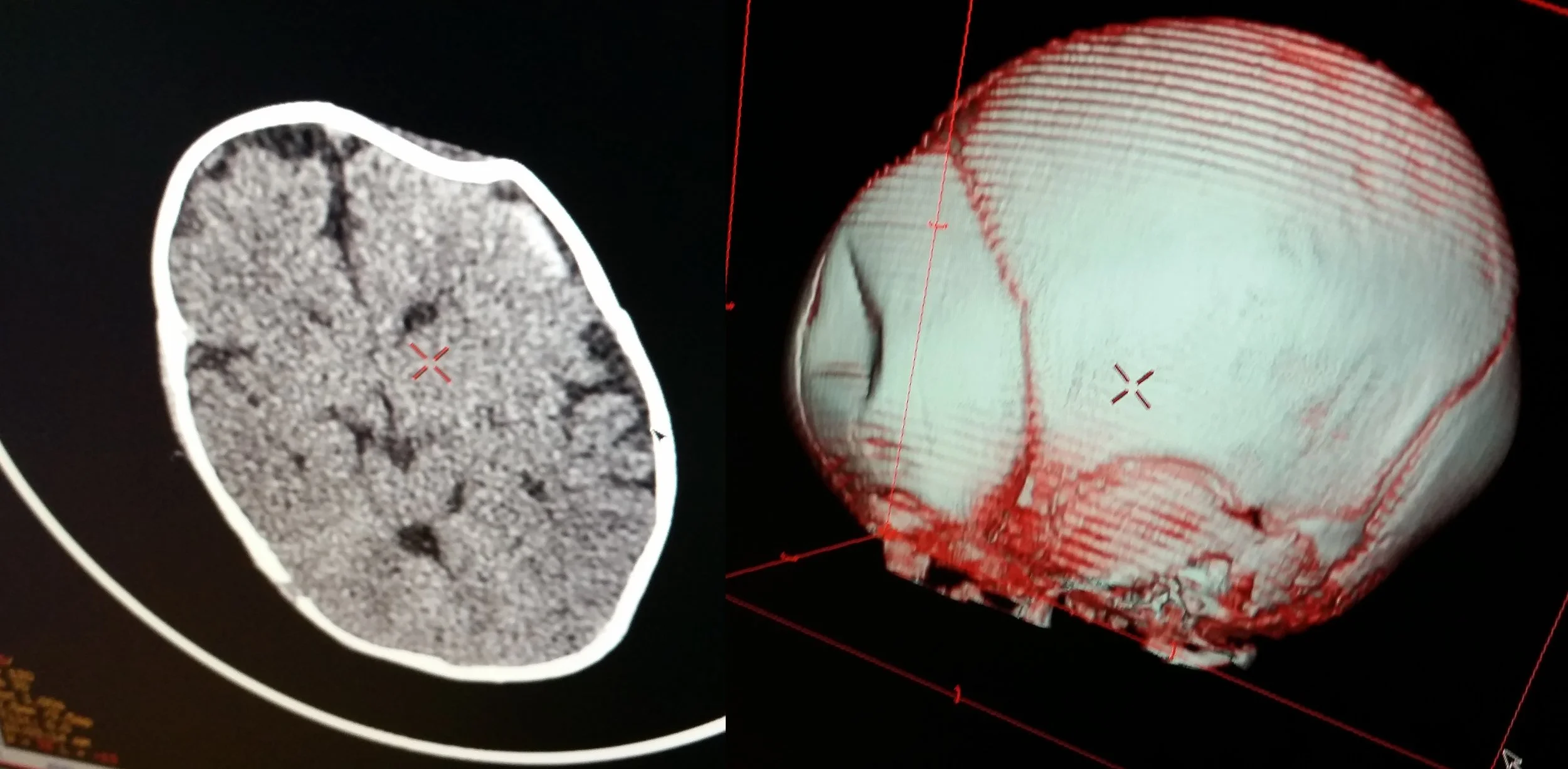 A standard CT scan on the left and a 3D view of the skull on the right. Both showing the obvious fracture or indention to the skull.