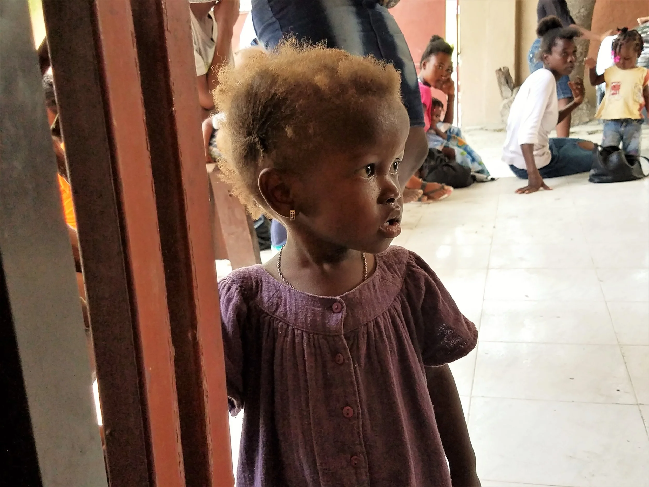 Malnutrition is devastation to mind and body. Her orange hair is due to chronic malnutrition