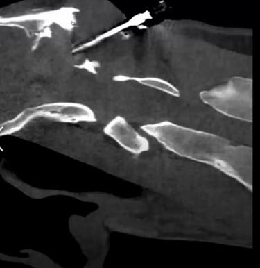 Osteomyelitis of the Occipital Bone