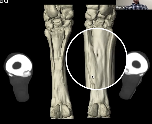 New Bone Formation on Splint Bones