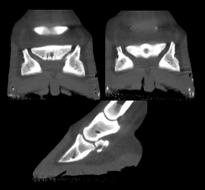 Navicular with Cyst Lesions