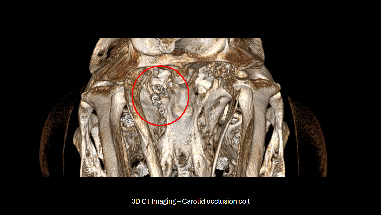 Occipital Bone Lysis and Hyperostosis