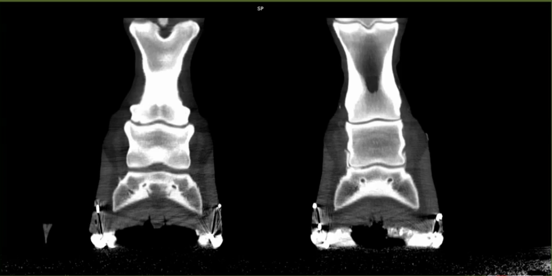  Coffin Joint Cartilage Loss on CT: What MRI Missed