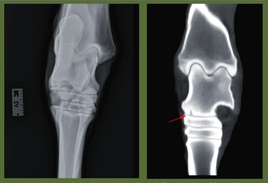 Detecting Talocalcaneal Joint Pathology with CT