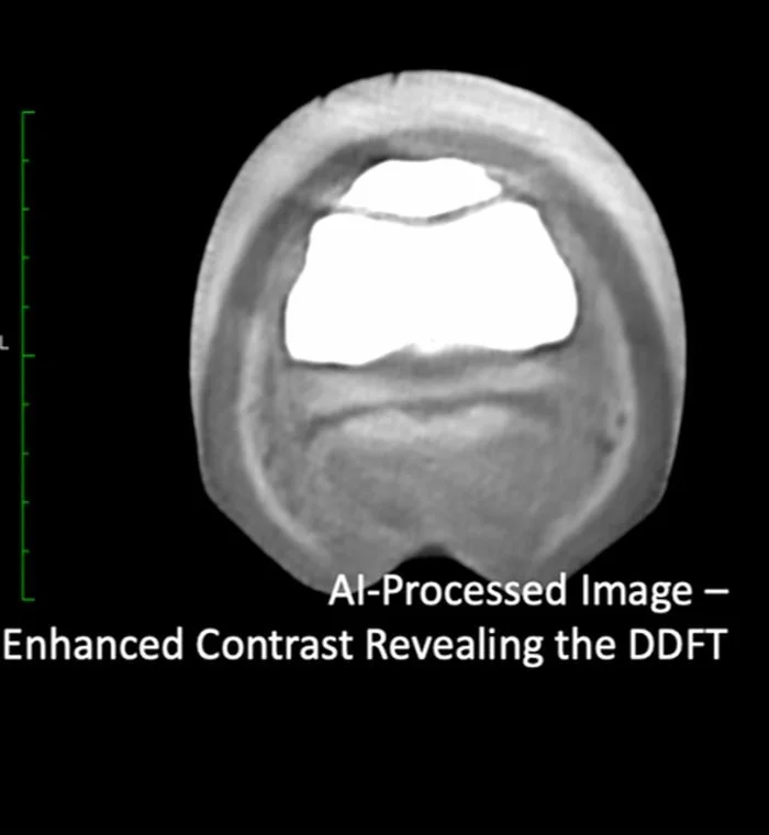 AI-processed CT slice with enhanced contrast revealing the DDFT