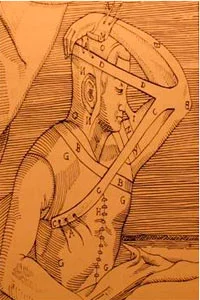 Gaspare Tagliacozzi (nasal reconstruction) –16th Century