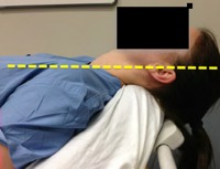 "The patient will be moved toward the head of the bed until the head and neck are resting on the edge of the mattress. Keeping the lower half of the bed flat, the head of the bed will be raised to an angle of 25°. The patients face will be parallel to the ceiling with neck in slight extension, torso at 25°, and legs parallel to the ceiling."