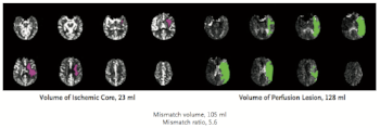 From cited article. Red infarct core is on the left. Green ischemic penumbra is on the right. 