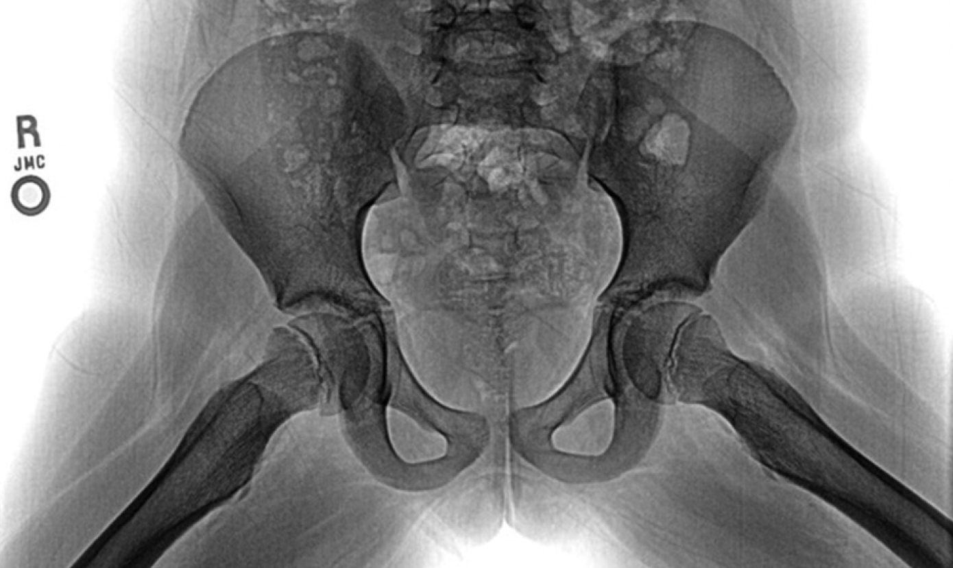 From cited article. Frog-leg lateral view. Can you spot the abnormality here?
