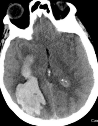 An example of the risk of tPA for mild stroke from the JAMA supplemental content .